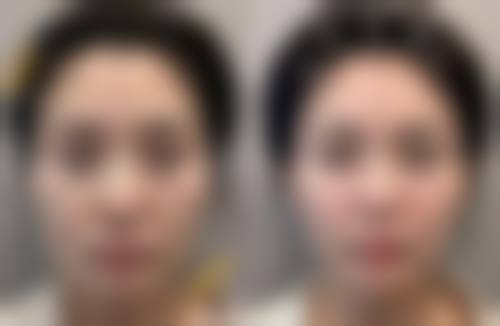 填充太阳凹，除了玻尿酸还有啥好材料？