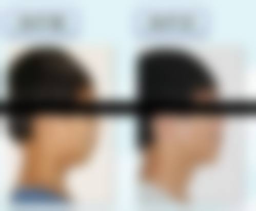 三、赵贵庆医生磨骨技术水平高