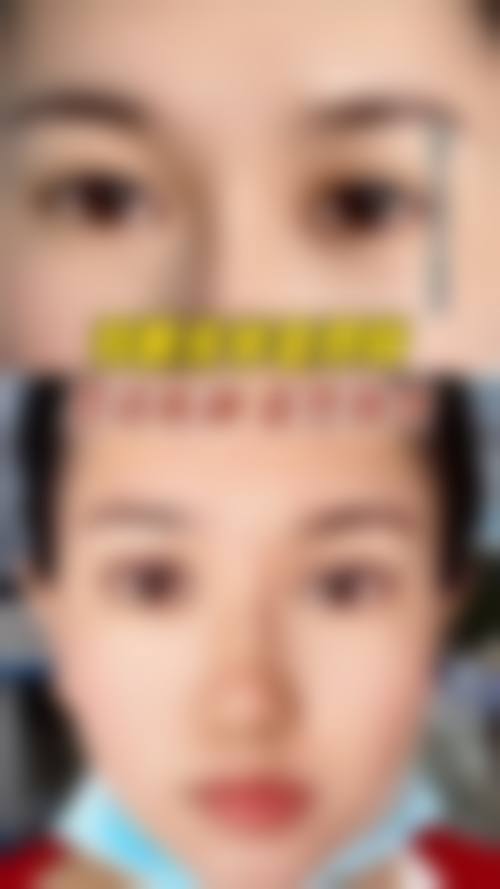 四、3位修复患者的真实蜕变：从"假面双眼皮"到"妈生感电眼"