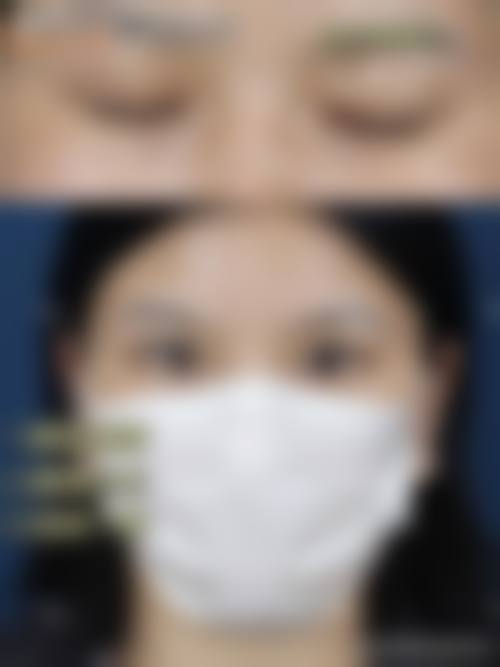 北京联合丽格第一医院吴焱秋医学博士TMF隐痕重睑修复28800元起,医学博士隐痕技术修复失败重睑效果自然