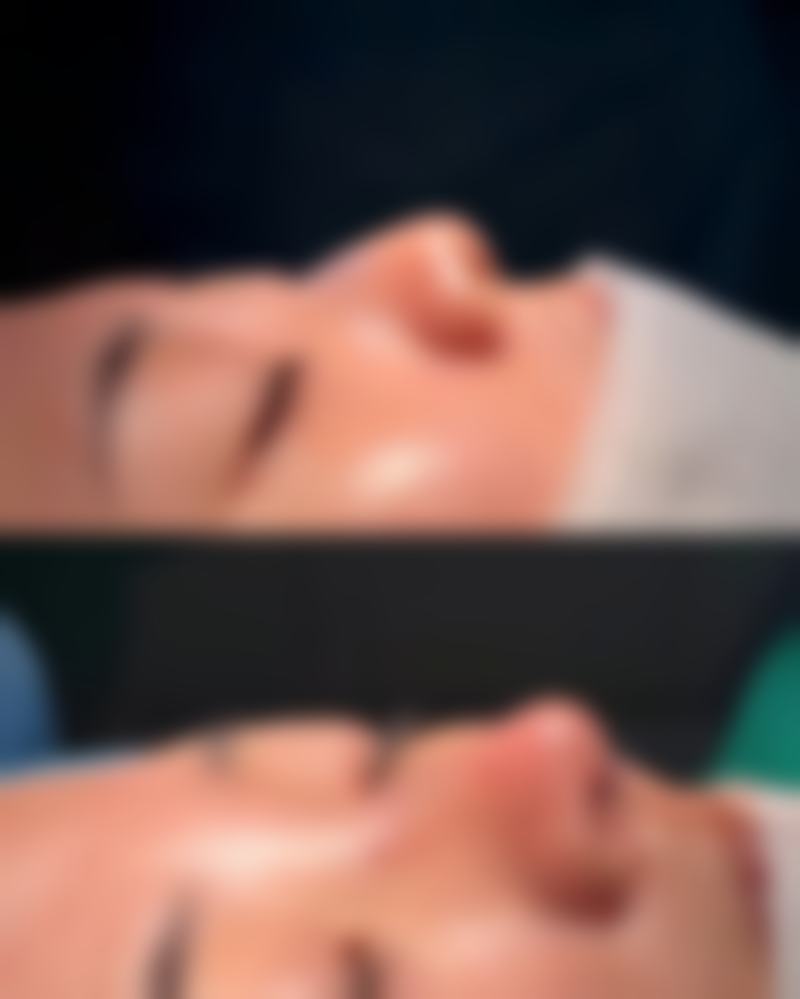 玻尿酸丰太阳穴，能维持多久成效？