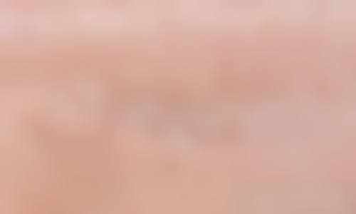 切开双眼皮留下的疤痕有哪些类型