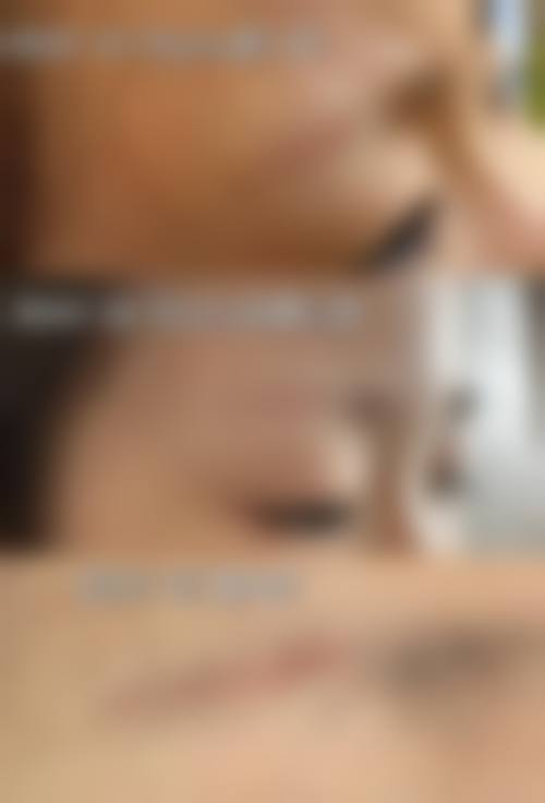 在决定是否选择切开双眼皮疤痕淡化前，普通用户更容易忽略的关键评估点及医院医生推荐