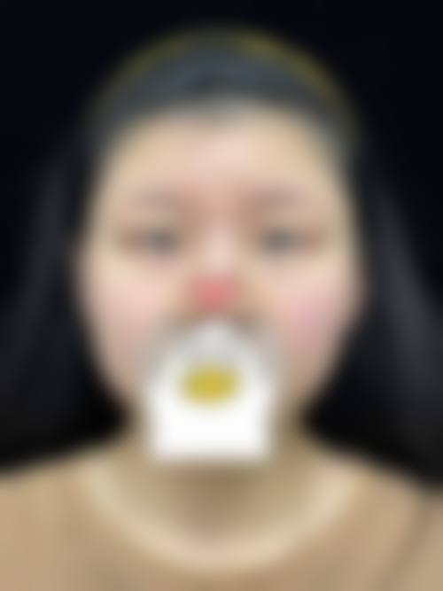 割双眼皮手术的优缺点分析