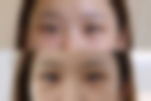 怎么判断我是否适合用眼膜去眼袋项目？