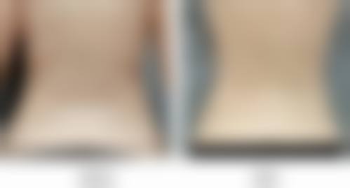 抽脂成效能否恒久维持的常见认知偏差与误解