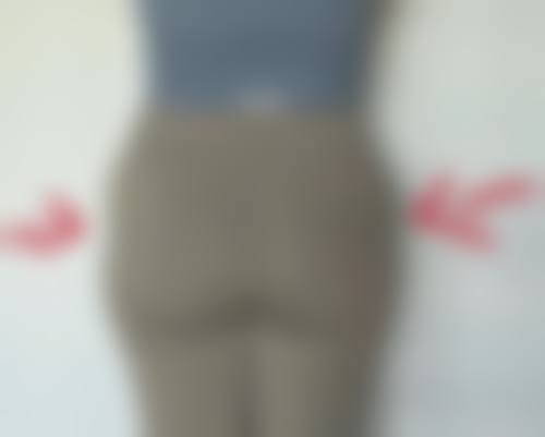 臀部吸脂需要全麻吗？麻醉方式与留院观察息息相关