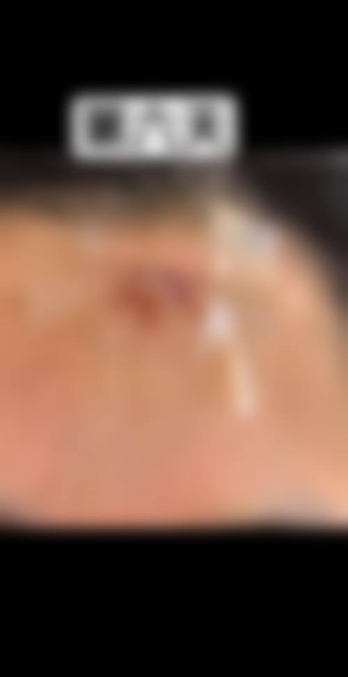 {烫疤痕增生如何消除？手术/激光/药物可选，激光800-6000元，药物治疗也有效！