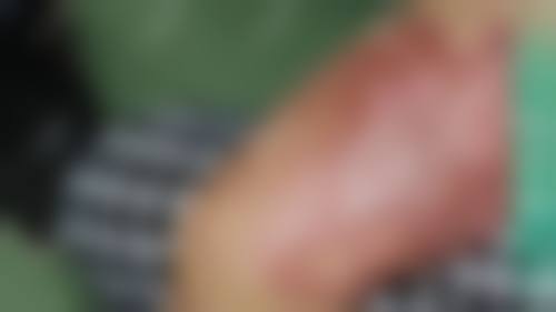 药物去除烫伤疤痕的成本投入分析