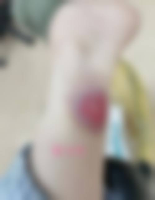 去除烫伤疤痕的预期目标是否现实