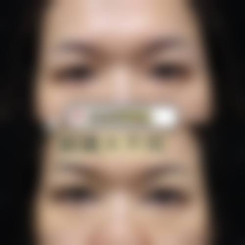 常见割双眼皮后“成效不明显”的真实原因有哪些