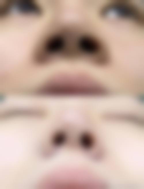 半肋骨隆鼻常见被误解或夸大的原理点