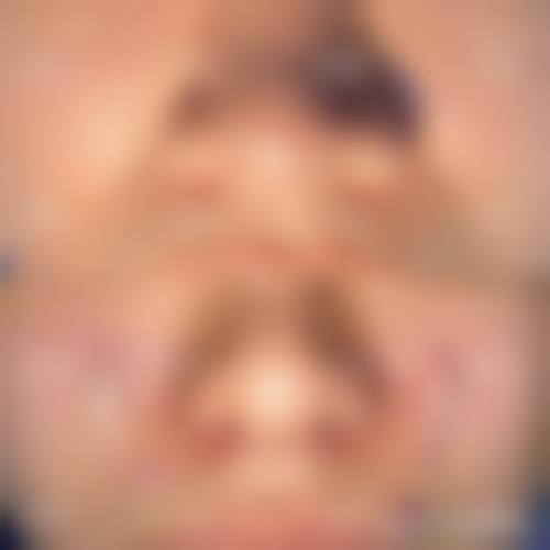 半肋骨隆鼻原理在哪些情况下容易失效或打折？