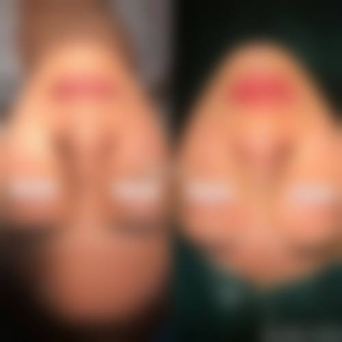 半肋骨隆鼻成分（体现在材料）在体内的作用过程