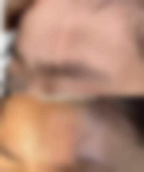 {疤痕留下黑色素多久淡化？通常3 - 6个月可自然淡化，积极护理能加速进程！激光、药物导入治疗助你快速祛疤淡黑！ 