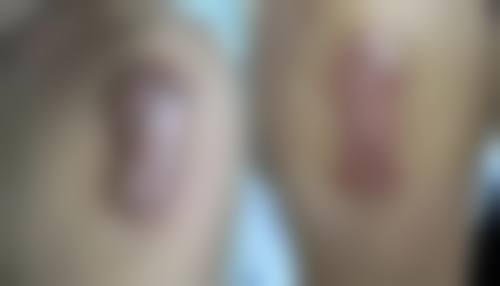 微晶磨皮，是消除凹陷疤痕的“秘密武器”吗？