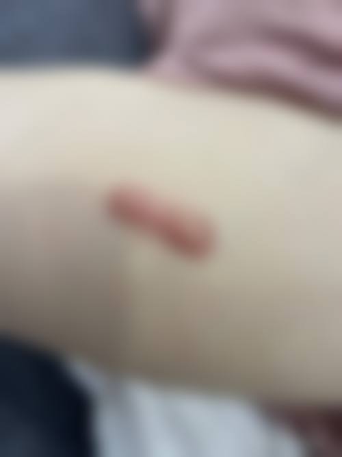 哪些人群在评估中更可能被建议考虑祛疤淡黑治疗？