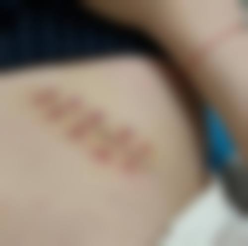 加速疤痕黑色素淡化的常见认知偏差与误解