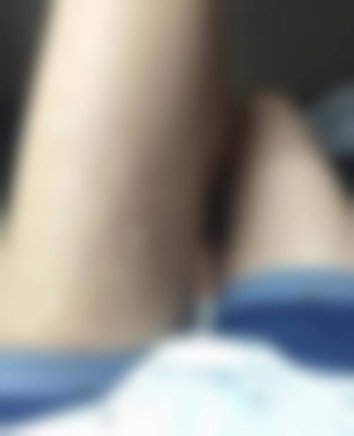 自然淡化与积极护理下疤痕黑色素淡化的对比