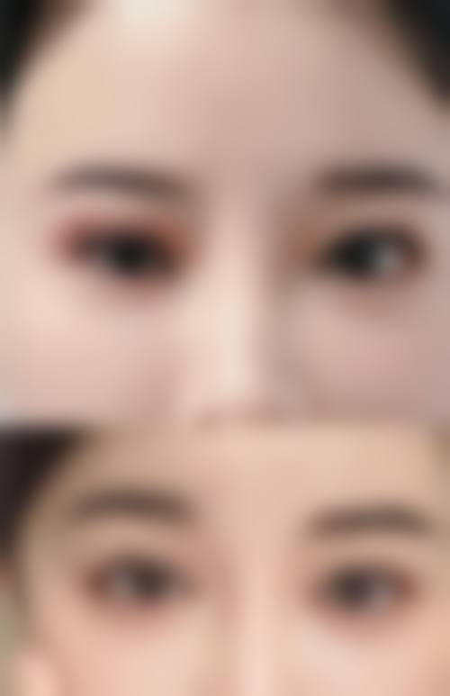 双眼皮8天拆线的区别