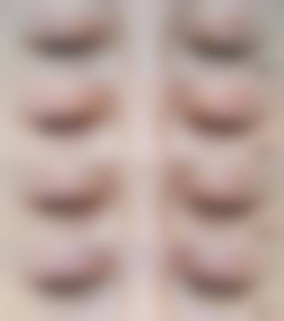 双眼皮8天拆线的价格区间及费用差异来源