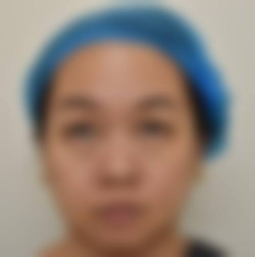 双眼皮8天拆线是什么？通常在什么医学背景下被选择？