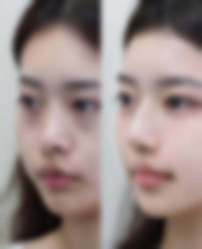 {十几年的凹陷疤痕怎么消除？微晶磨皮、激光治疗、填充法三招齐下消除率高达80%！效果及收费全解析