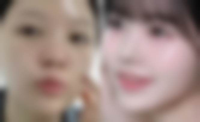 填充法，快速填平凹陷疤痕的“魔法药剂”？