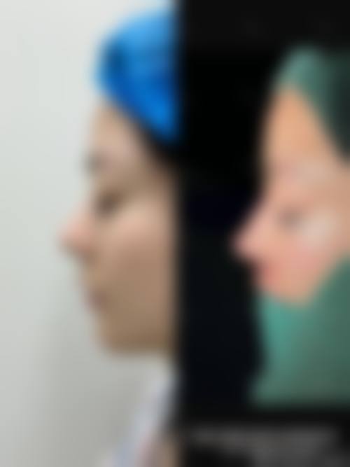 从医学角度看,肋骨隆鼻的风险主要集中在哪些环节?