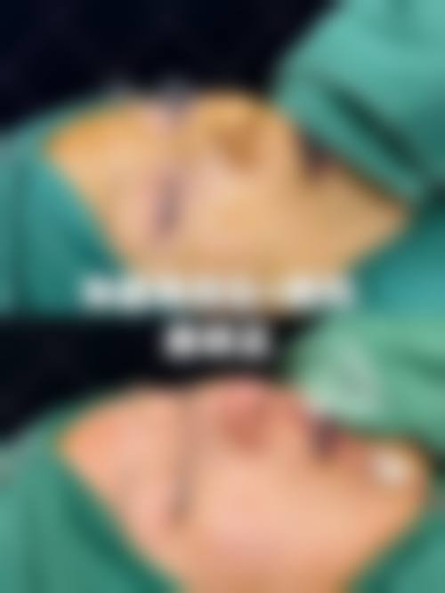 肋骨隆鼻是什么?通常在什么医学背景下被选择?