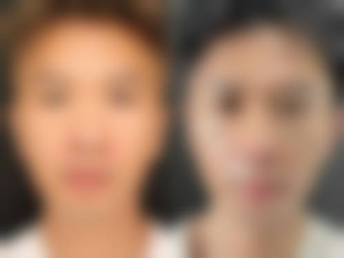 哪些人群在评估中更可能被建议考虑肋骨隆鼻?