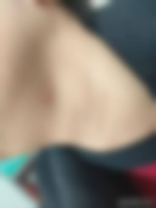 {凸出疤痕怎么去除？激光祛疤3次见效，手术切除1-3万起，效果对比图来了！