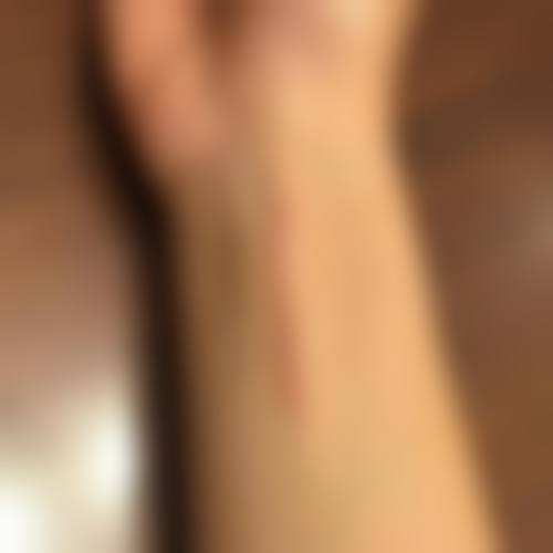 积极治疗,如何加速疤痕增生修复?