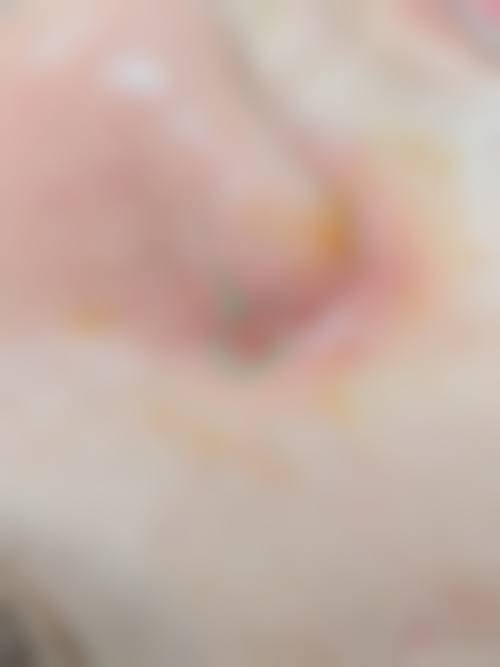 在决定是否选择肋骨隆鼻前,普通用户更容易忽略的关键评估点