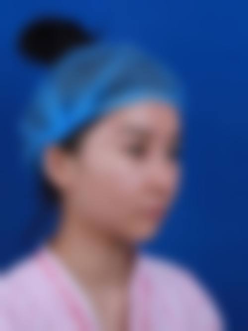 {抽脂填充脸部多久恢复？一般1-3个月基本恢复，个体差异与护理情况究竟如何影响恢复时间？ 