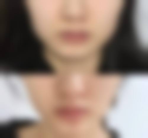 抽脂填充脸部本身能解决什么、不能解决什么？