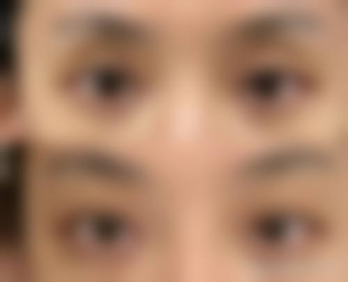 改善黑眼袋治疗存在哪些风险？