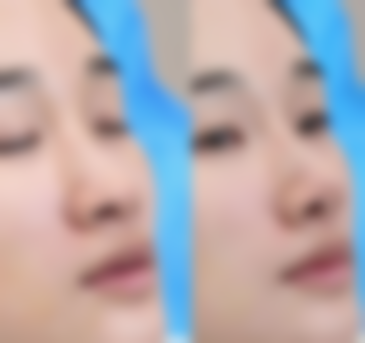 不同成因的黑眼袋有哪些改善方法？