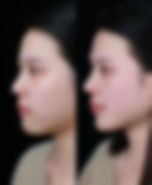 肋骨隆鼻的价格区间及费用差异来源