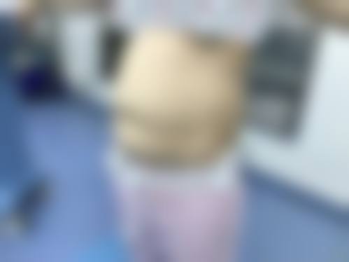 腰部抽脂减肥常见并发症或后遗问题，在临床中如何理解其发生概率？