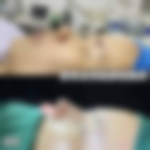 线提升隆鼻顶线自己消失的可能性大吗