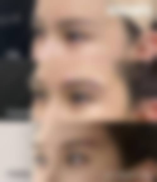 八、做完双眼皮拆线后美眼成效的稳定性取决于哪些因素？