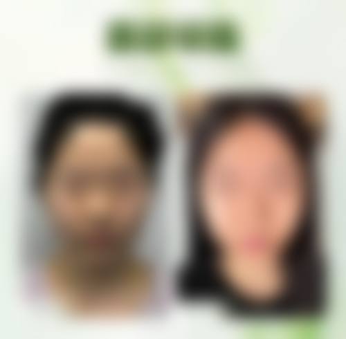 瘦脸针是什么？通常在什么医学背景下被选择？