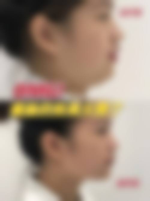 瘦脸针的价格区间及费用差异来源