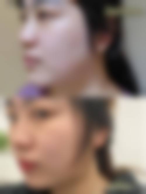 在决定是否选择瘦脸针前，普通用户更容易忽略的关键评估点