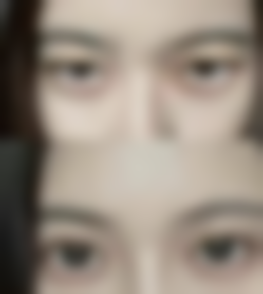 从医学角度看，眼霜去眼袋的风险主要集中在哪些环节？