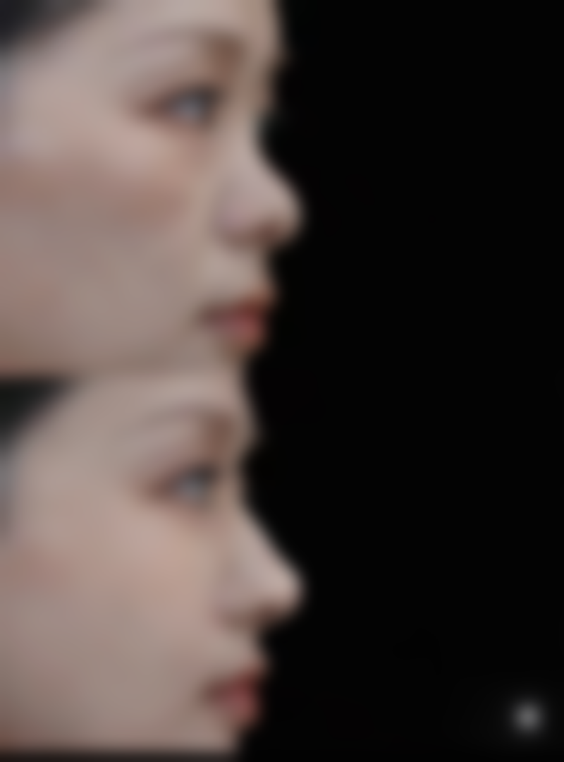 线提升隆鼻顶线了怎么办