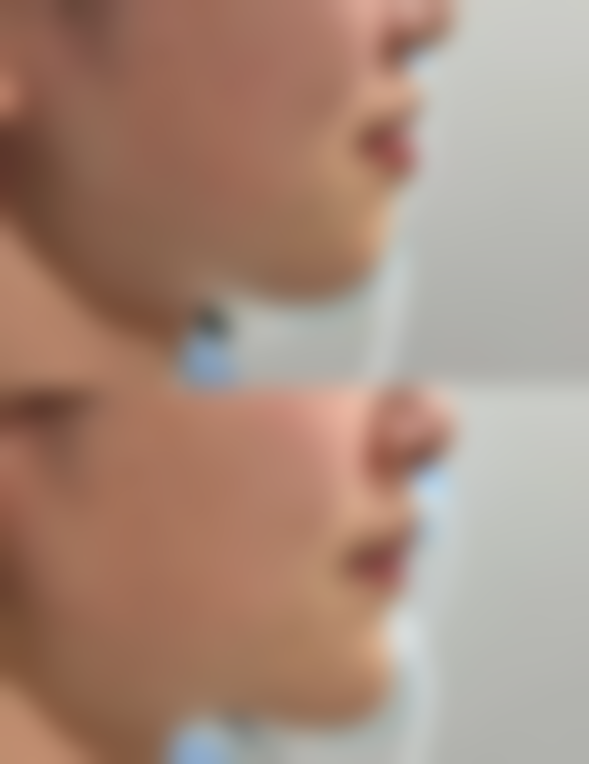 {线雕隆鼻为什么会顶线？原来是线材质量不佳、植入过浅和术后护理不当在作祟！线雕隆鼻顶线了怎么办？取出线头+术后清洁是关键！ 