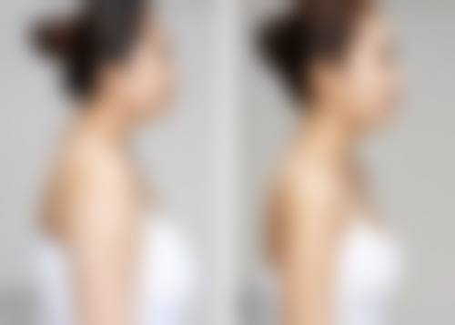 45岁以后还能隆胸吗？能！身体条件允许、手术技术成熟且有成功案例支撑！45岁后隆胸可行性高，假体与自体脂肪隆胸任你选！ 