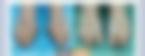 十一、在决定阴道前后壁修复手术前，普通用户更容易忽略的关键信息